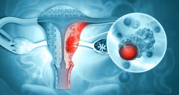 doctor for endometriosis in mumbai